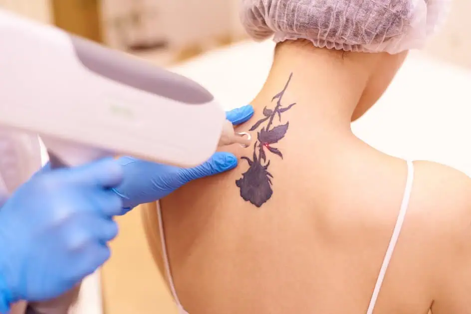 Laser Tattoo Removal by Viva Care Solutions in Philadelphia, PA