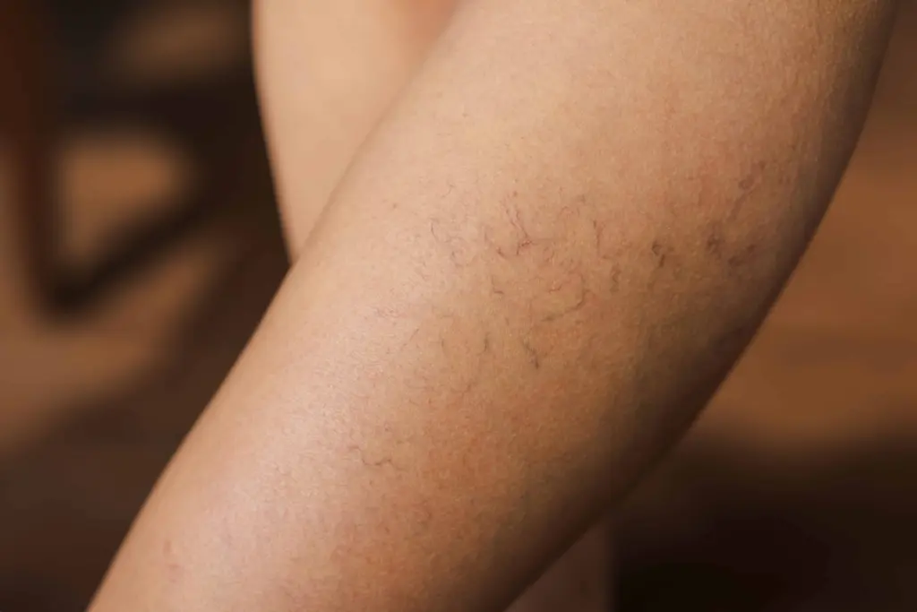 Vasculaze Laser